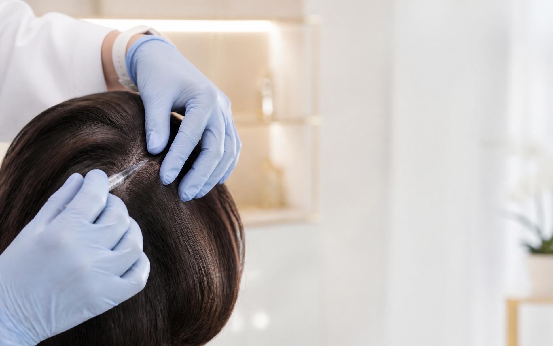 PRP cheveux — micro-injection dans le cuir chevelu chez Zenith Aesthetic Clinic
